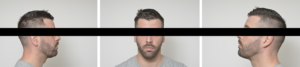 Photographe-ollioules-portraitiste-de-france-famille-enfant-bébé-mariage-toulon-var-PHOTOS POUR CHIRURGIE ESTHETIQUE Maxillo-faciale Rhinoplastie